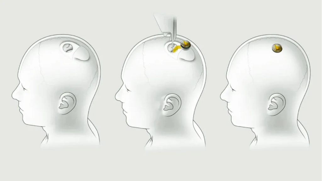 马斯克确认：首位患者接受Neuralink脑机芯片植入手术，恢复良好